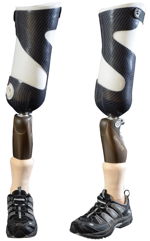 Versorgung am Patienten mit einer Knie-Ex-Prothese